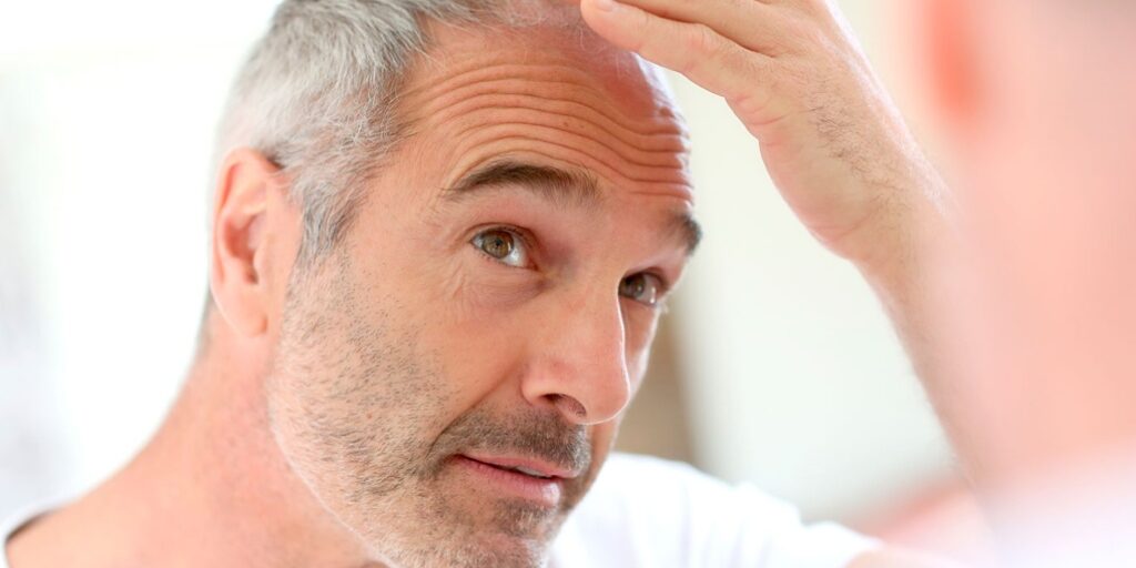 injerto-capilar-barcelona Trasplante capilar como solución para la calvicie