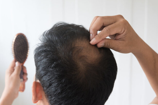 alopecia-genetica Pérdida de cabello genética