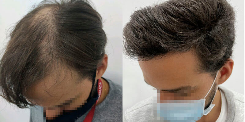 Caso real Injerto capilar 2.575 UFS