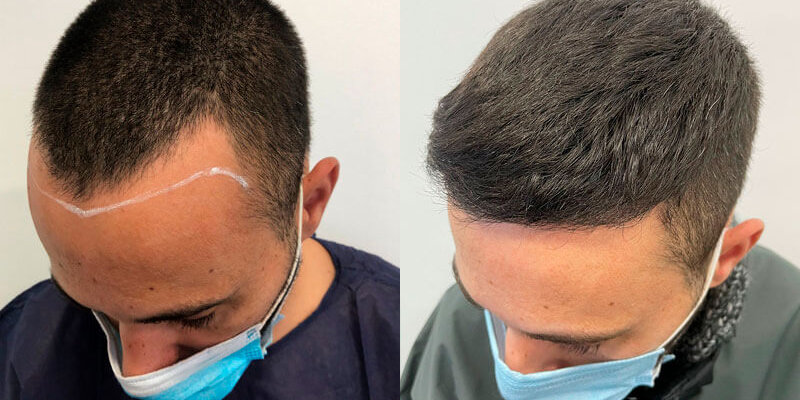 Injerto capilar caso real en Barcelona Injerto capilar caso real en Barcelona