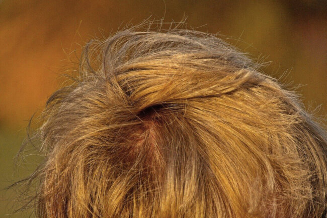 Alopecia por cicatriz