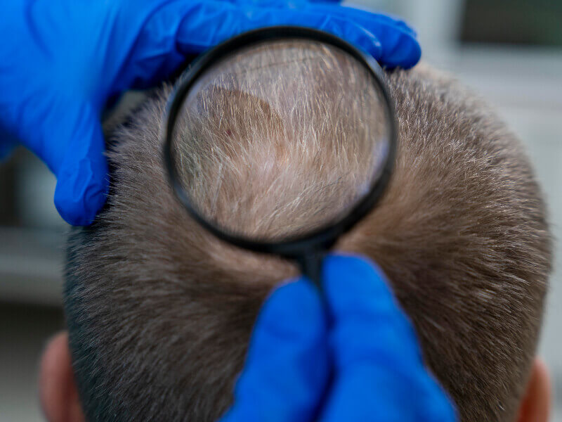 Dihidrotestosterona y alopecia