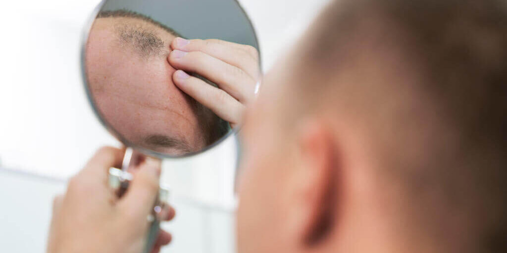 Dihidrotestosterona y alopecia: ¿qué relación existe?
