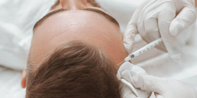 tecnica-fue-pelo-prp-capilar