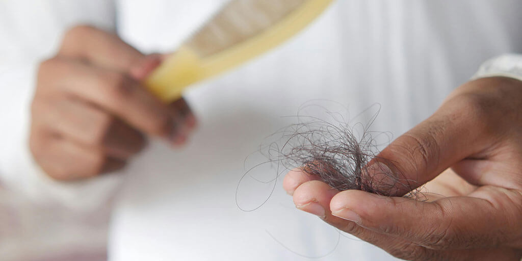 Alopecia areata y estrés Alopecia areata y estrés