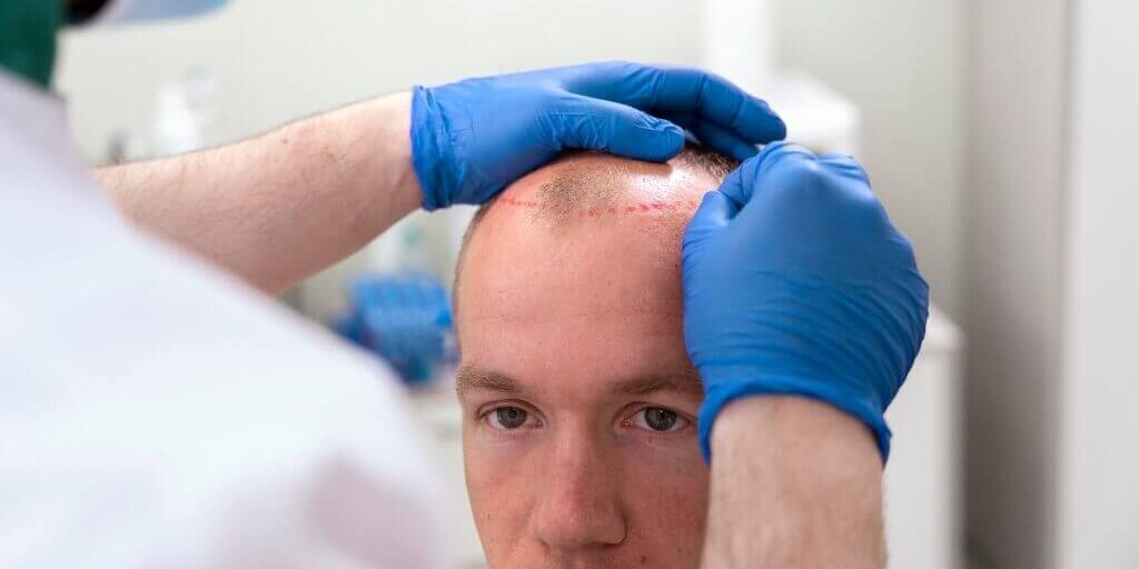 clonacion-capilar-1-1