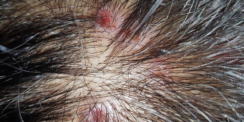 hemagioma-capilar-que-son-1