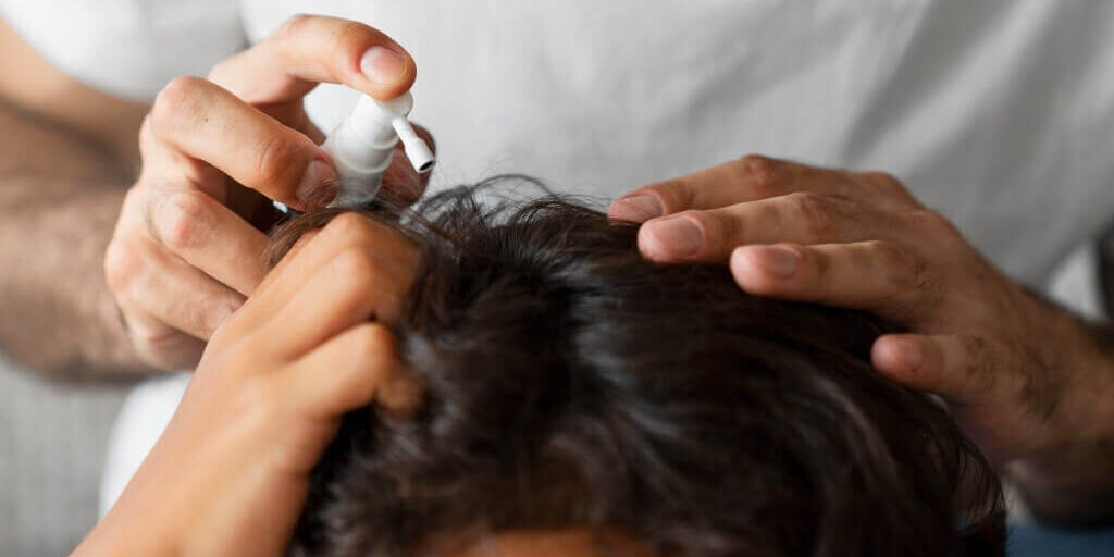 tratamiento-minoxidil