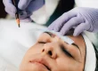 Implante de cejas