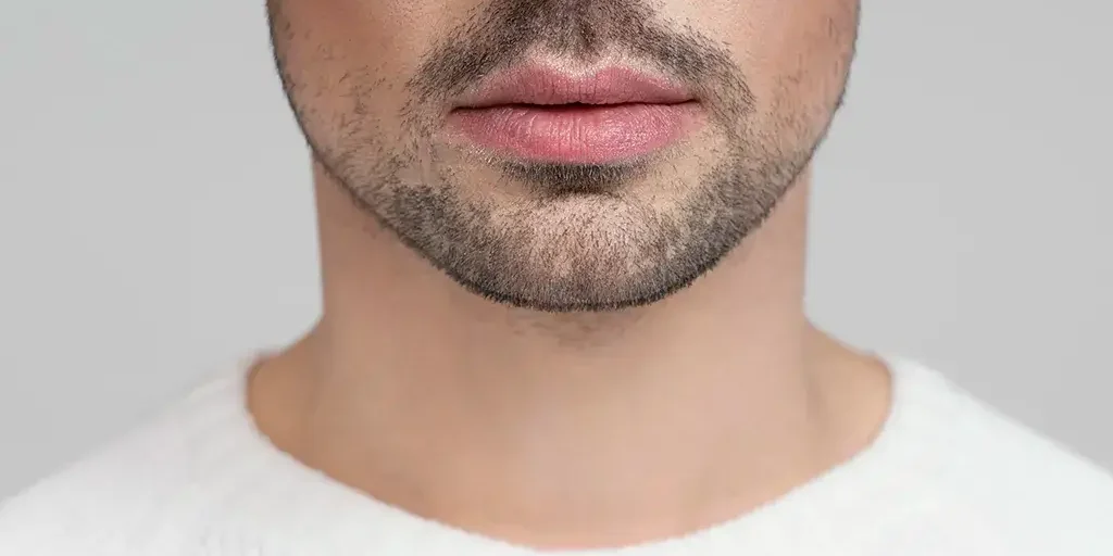 injerto de barba injerto de barba