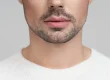 injerto de barba