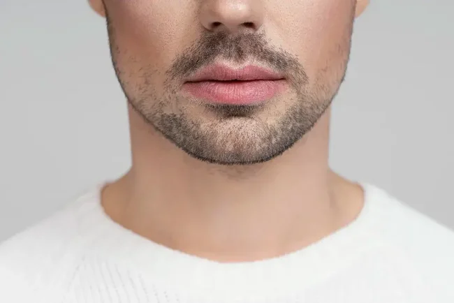 injerto de barba injerto de barba