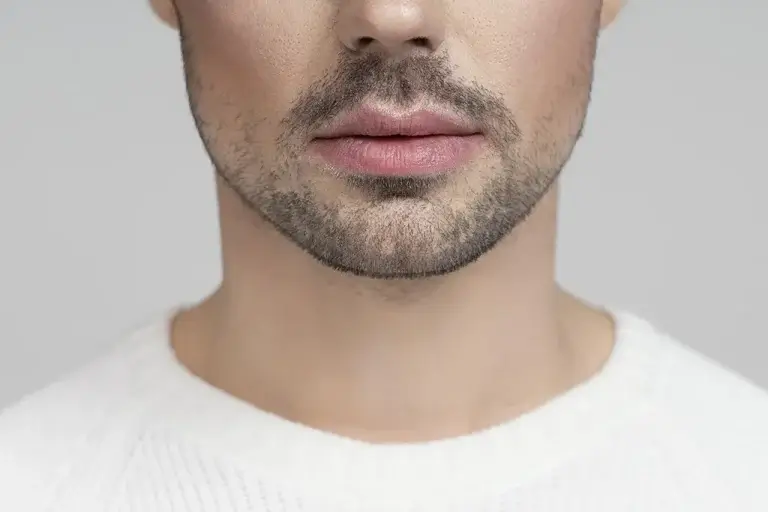 injerto de barba injerto de barba